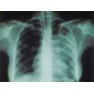 Туберкулёз: признаки, формы и виды