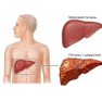 Цирроз печени: стадии и виды