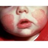 Детская аллергия: окончательный диагноз или нет???