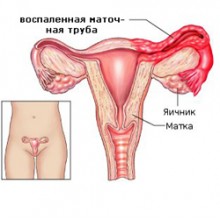 Аднексит (сальпингоофорит) Аднексит (сальпингоофорит)