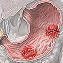 Язвенная болезнь желудка и двенадцатиперстной кишки