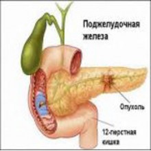 Рак поджелудочной железы Рак поджелудочной железы