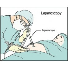 Лапароскопия