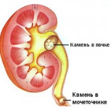 Мочекаменная болезнь (Камни в почках)