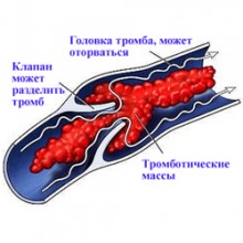 Тромбофлебит Тромбофлебит