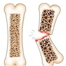 Остеопороз